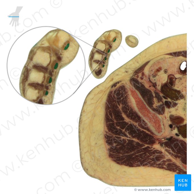 Tendons of flexor digitorum superficialis muscle (Tendines musculi flexoris digitorum superficialis); Image: National Library of Medicine