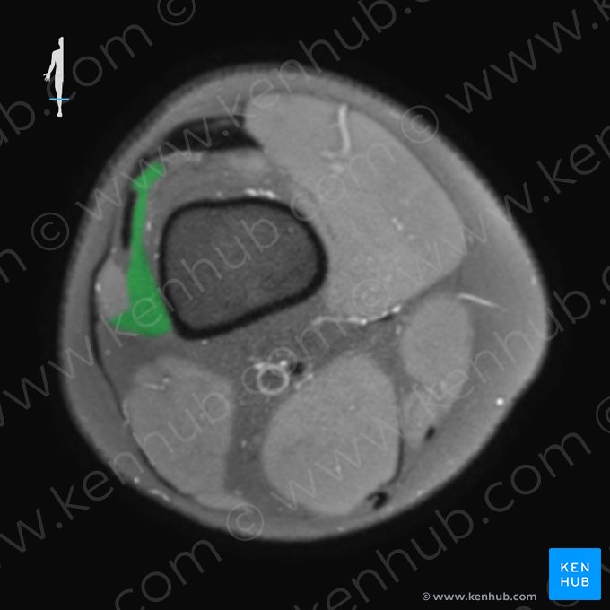 Muscle vaste intermédiaire (Musculus vastus intermedius); Image : 