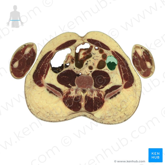 Colon descendens (Absteigender Dickdarm); Bild: National Library of Medicine