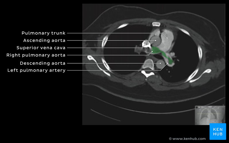 CT showing pulmonary embolism