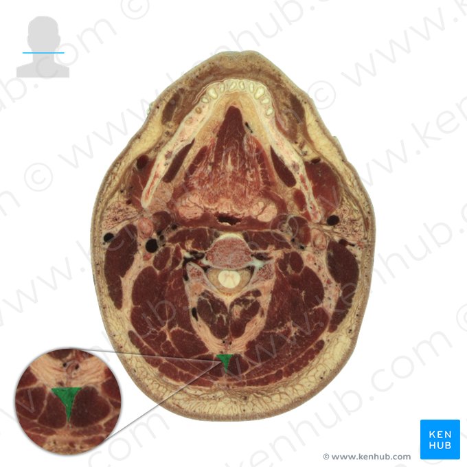 Nuchal ligament (Ligamentum nuchae); Image: National Library of Medicine