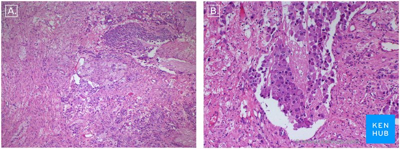 Figure 4: Histological appearance of the tumor. H&E Stain. A. 10X B. 40X