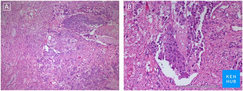 Figure 4: Histological appearance of the tumor. H&E Stain. A. 10X B. 40X