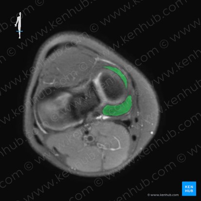 Menisco medial (Meniscus medialis); Imagen: 