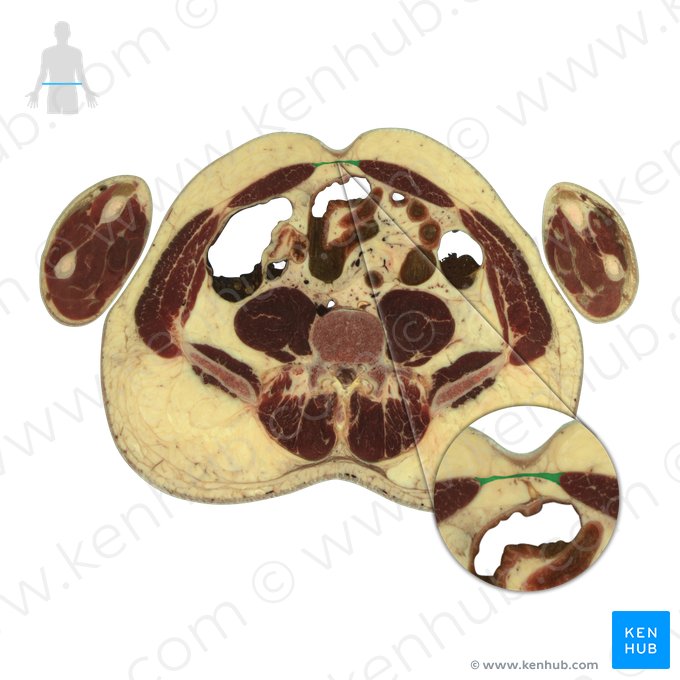 Linea alba (Weiße Linie); Bild: National Library of Medicine