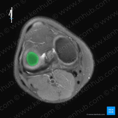 Lateral condyle of femur (Condylus lateralis ossis femoris); Image: 