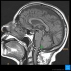 Clinical case: Oculomotor nerve palsy and distal myopathy