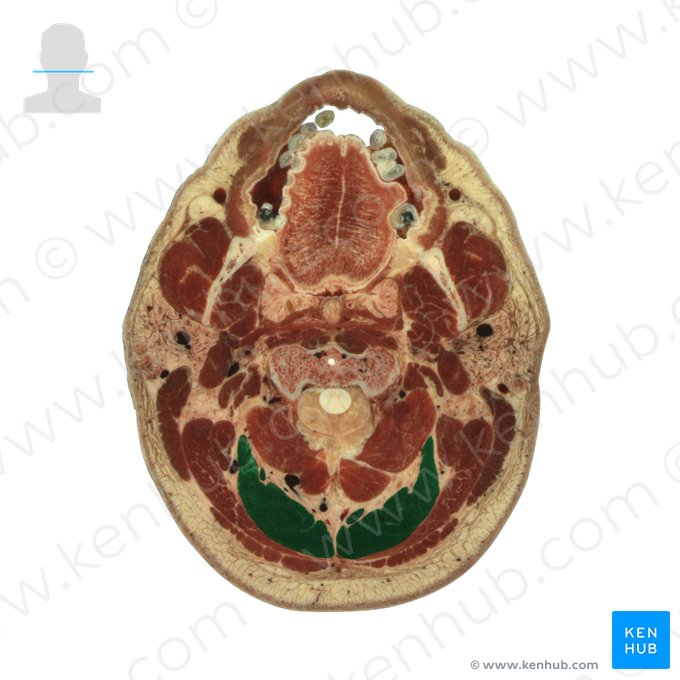 Semispinalis capitis muscle (Musculus semispinalis capitis); Image: National Library of Medicine