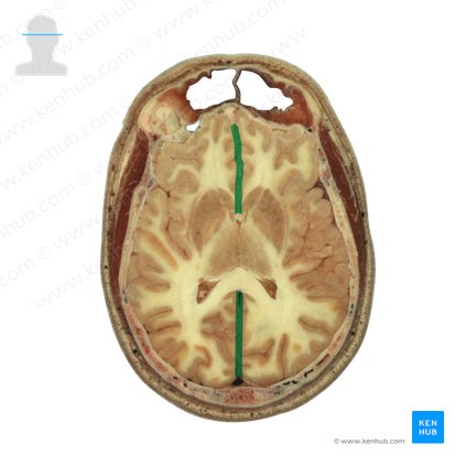 Longitudinal cerebral fissure (Fissura longitudinalis cerebri); Image: National Library of Medicine