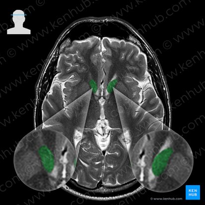 Caput nuclei caudati (Kopf des Schweifkerns); Bild: 