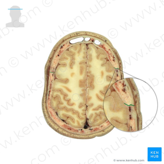 Sutura coronalis (Kranznaht); Bild: National Library of Medicine