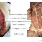 Clinical case: Necrotizing fasciitis of the anterior abdominal wall