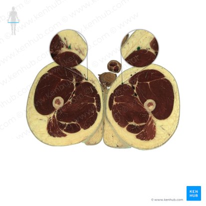 Vena saphena magna (Große Rosenvene); Bild: National Library of Medicine