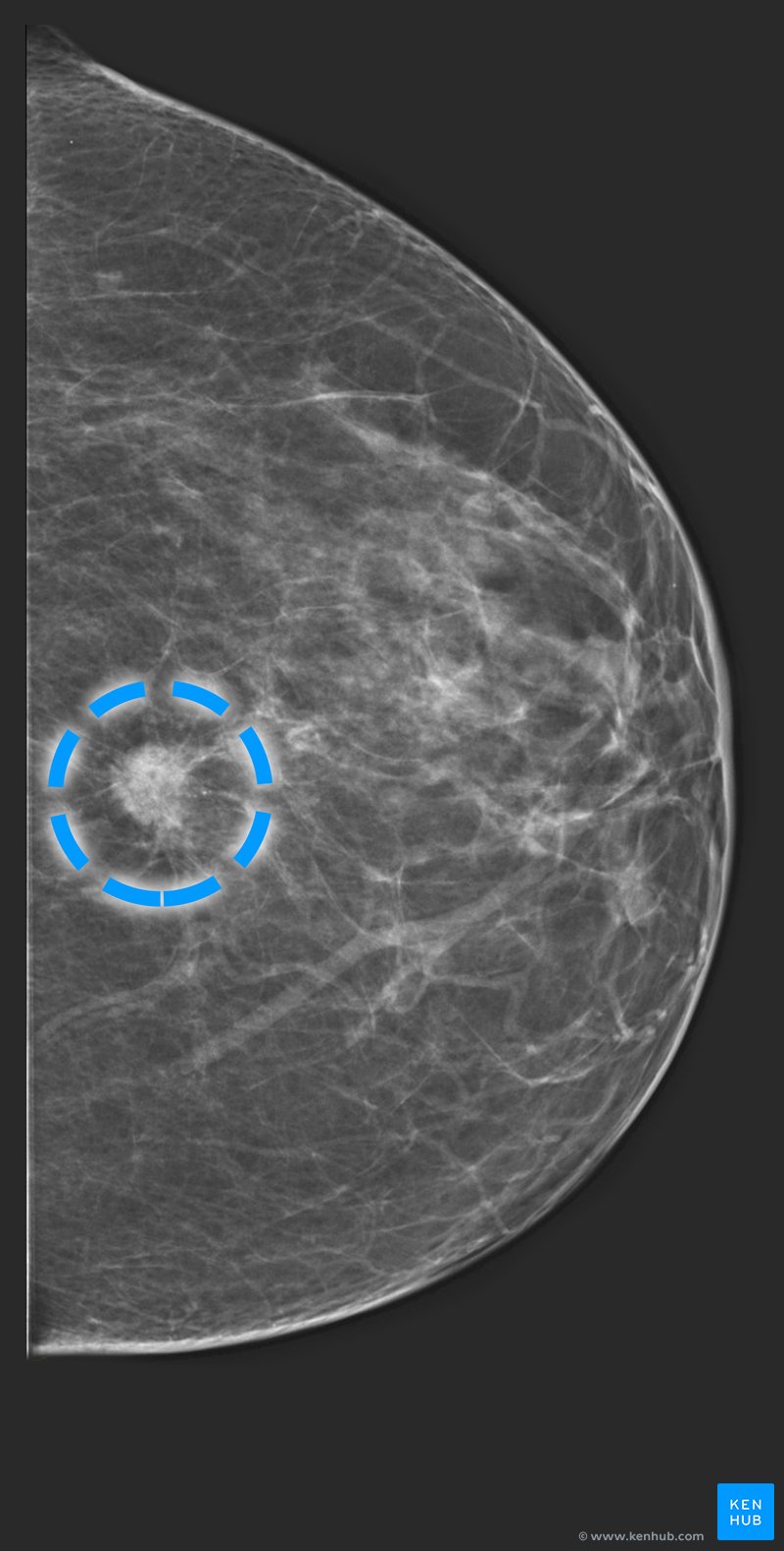 Invasive Ductal Carcinoma - Mammography