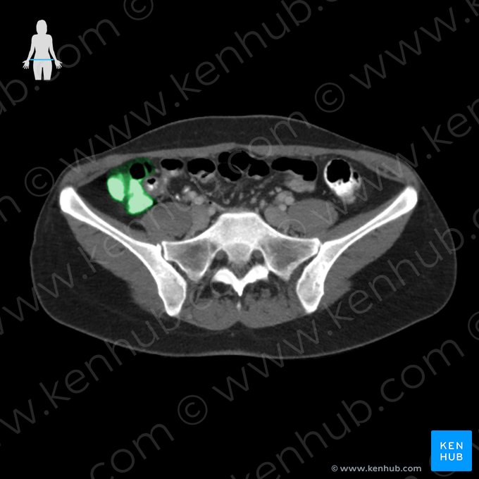 Cecum (Caecum); Image: 