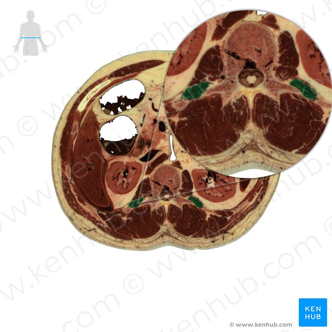 Músculo quadrado lombar (Musculus quadratus lumborum); Imagem: National Library of Medicine