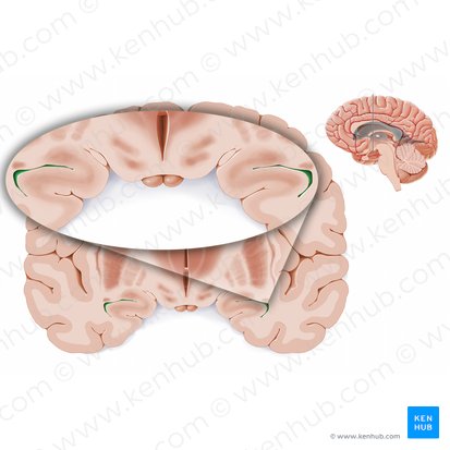 Asta temporal del ventrículo lateral (Cornu temporale ventriculi lateralis); Imagen: Paul Kim