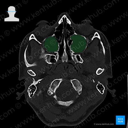 Sinus maxillaris (Kieferhöhle); Bild: 