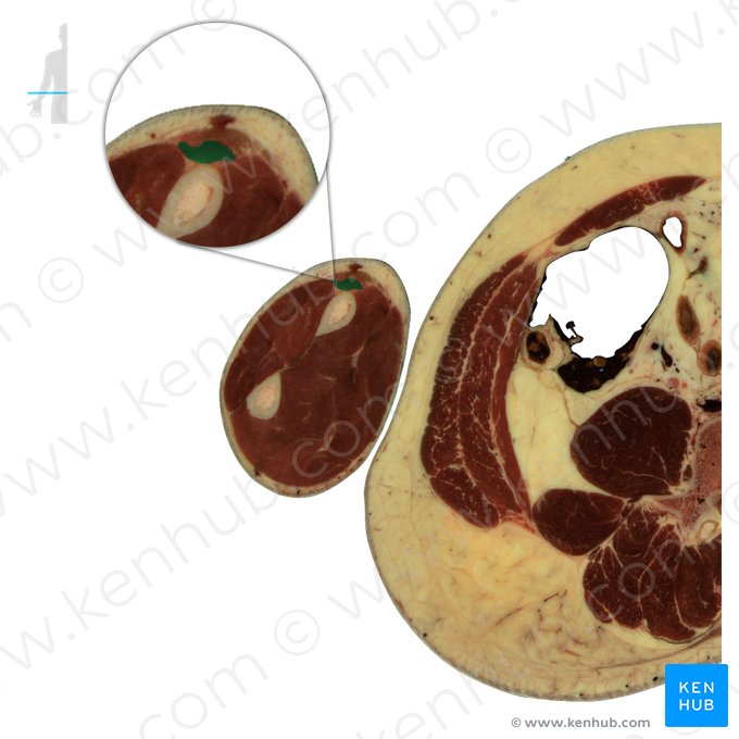 Musculus extensor carpi radialis brevis (Kurzer speichenseitiger Handstrecker); Bild: National Library of Medicine