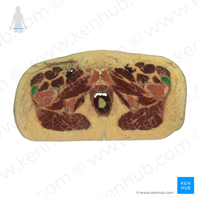 Músculo glúteo médio (Musculus gluteus medius); Imagem: National Library of Medicine