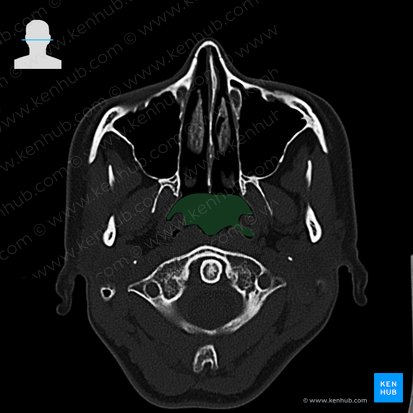 Nasopharynx (Pars nasalis pharyngis); Image: 