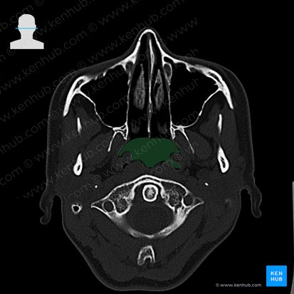 Nasofaringe (Pars nasalis pharyngis); Imagen: 