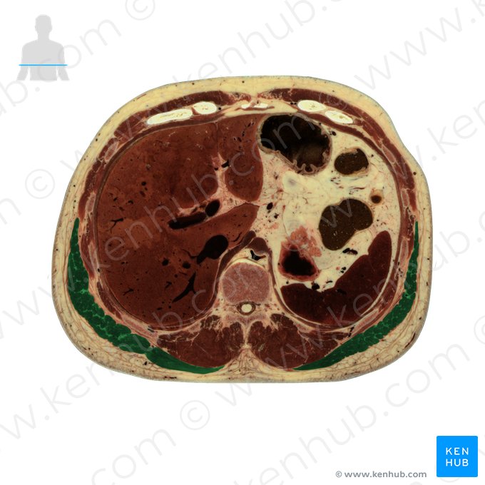 Latissimus dorsi muscle (Musculus latissimus dorsi); Image: National Library of Medicine