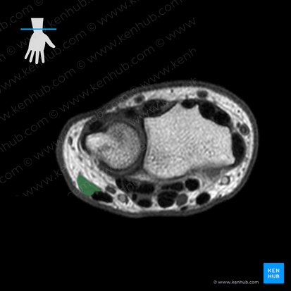Flexor carpi ulnaris muscle (Musculus flexor carpi ulnaris); Image: 