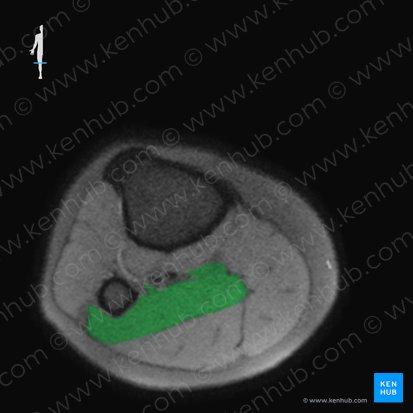 Musculus soleus (Schollenmuskel); Bild: 