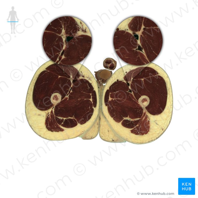 Vena femoralis (Oberschenkelvene); Bild: National Library of Medicine