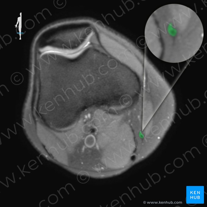 Tendão do músculo grácil (Tendo musculi gracilis); Imagem: 