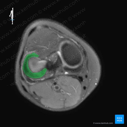 Menisco lateral (Meniscus lateralis); Imagen: 