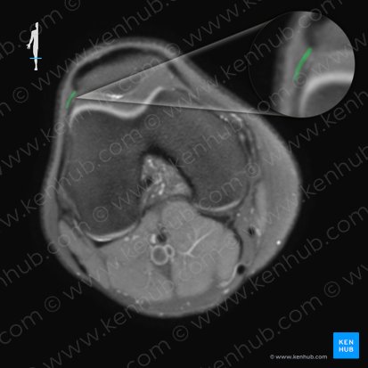 Retinaculum patellae laterale (Äußerer Kniescheibenzügel); Bild: 