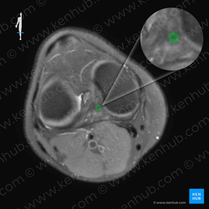 Ligamento cruzado posterior (Ligamentum cruciatum posterius); Imagen: 