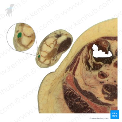 Tendão do músculo extensor do dedo mínimo (Tendo musculi extensoris digiti minimi); Imagem: National Library of Medicine