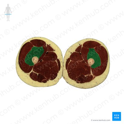 Músculo vasto intermedio (Musculus vastus intermedius); Imagen: National Library of Medicine