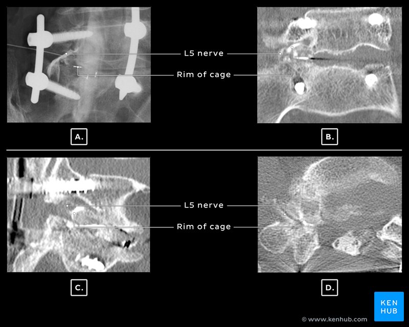 Myelogram