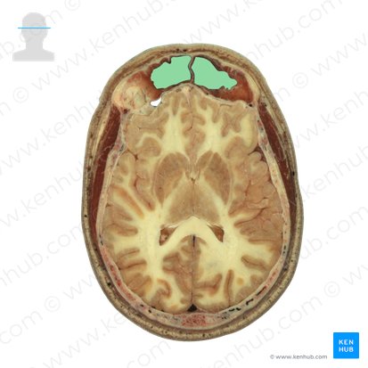 Frontal sinus (Sinus frontalis); Image: National Library of Medicine