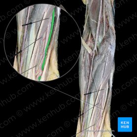 Ulnar nerve (Nervus ulnaris); Image: 