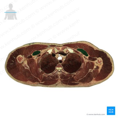 Pectoralis minor muscle (Musculus pectoralis minor); Image: National Library of Medicine