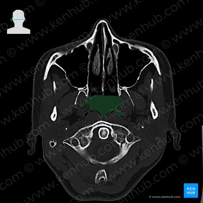 Nasopharynx (Pars nasalis pharyngis); Image: 