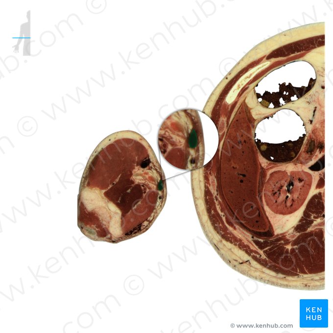 Veia cubital mediana (Vena mediana cubiti); Imagem: National Library of Medicine