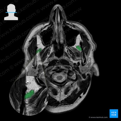 Musculus temporalis (Schläfenmuskel); Bild: 