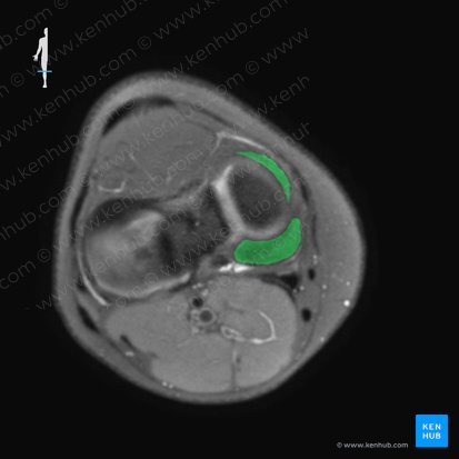 Menisco medial (Meniscus medialis); Imagen: 