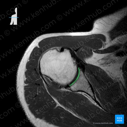 Cavidad glenoidea de la escápula (Fossa glenoidalis scapulae); Imagen: 