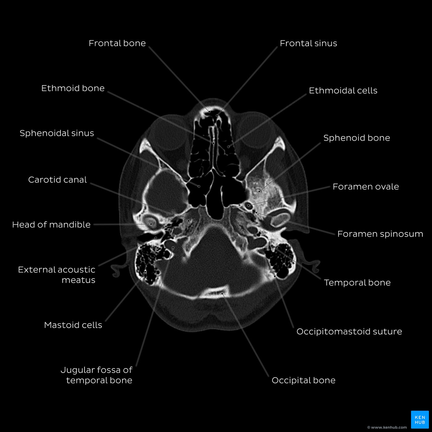 Head CT overview: Jugular fossa level