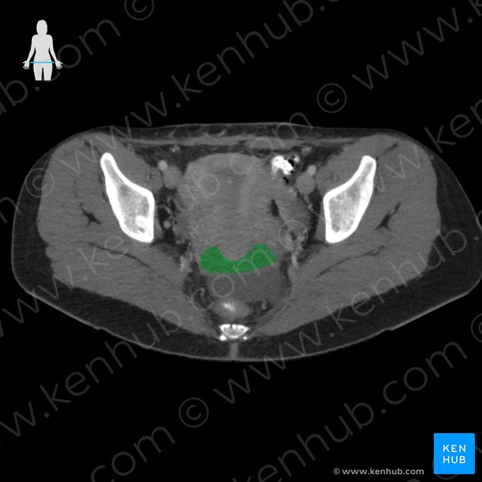 Fórnice da vagina (Fornix vaginae); Imagem: 