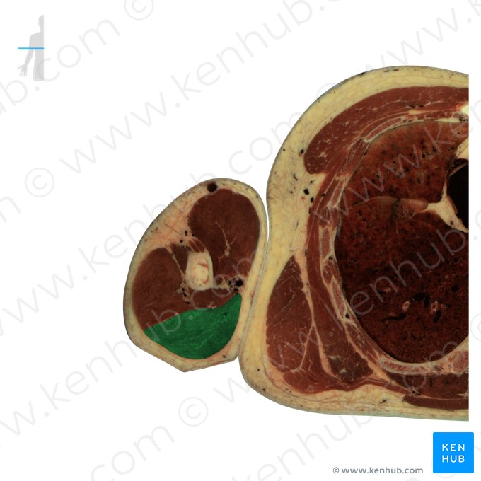 Cabeça longa do músculo tríceps braquial (Caput longum musculi tricipitis brachii); Imagem: National Library of Medicine