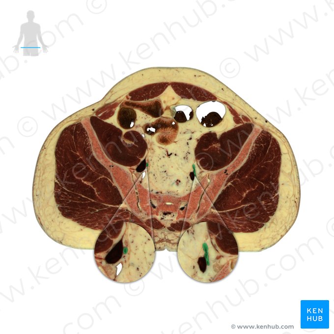 Arteria iliaca interna (Innere Beckenarterie); Bild: National Library of Medicine