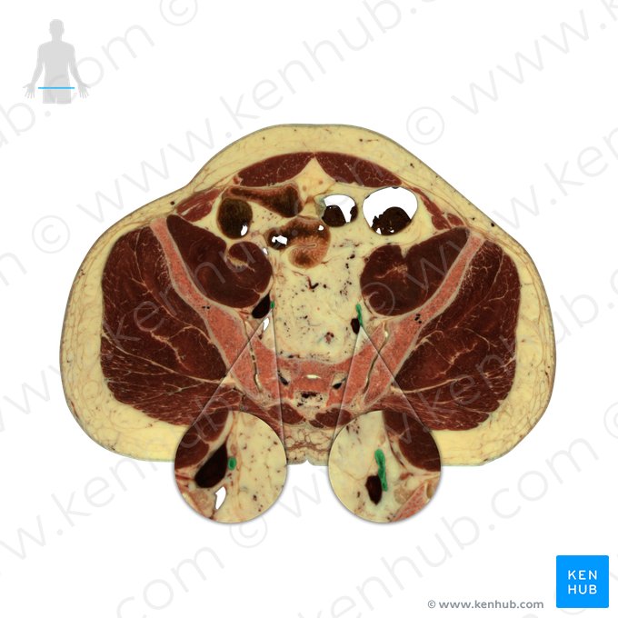 Artéria ilíaca interna (Arteria iliaca interna); Imagem: National Library of Medicine